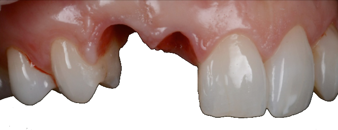 PrÃ©paration du dentiste en bouche des dents 22 et 23