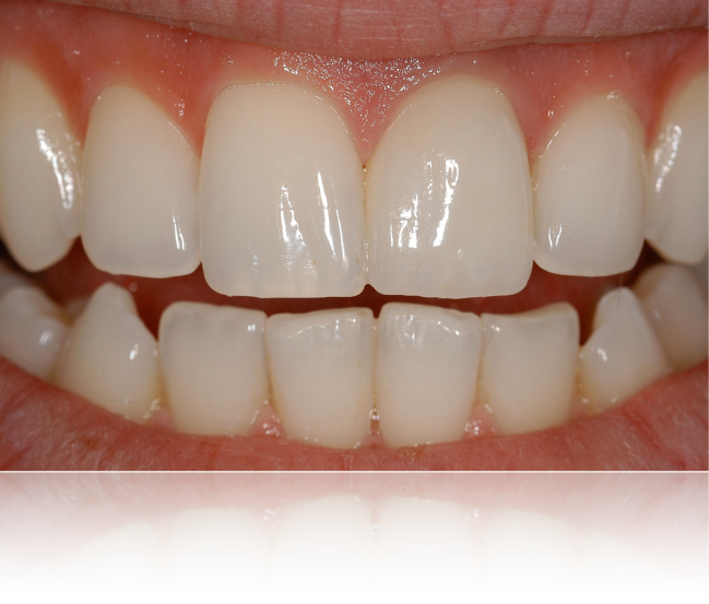 dent 21 en bouche passe inaperÃ§u parmi les dents naturelles