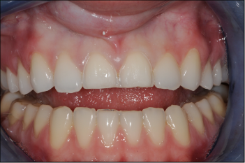 prÃ©pration du dentiste des dents 11 et 21 pour facettes de porcelaine feldspathique