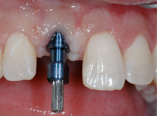 implant en bouche Ã  la dent 11