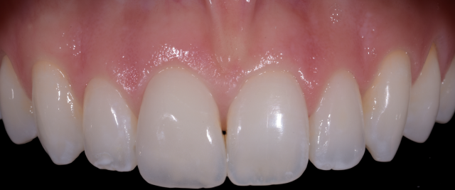 dents supÃ©rieures avec micro facette sur la dent 11