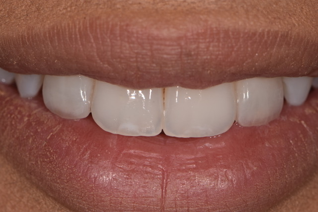 sourire de personne portant les facettes 22 et 12 ne montre que les dents supÃ©rieures